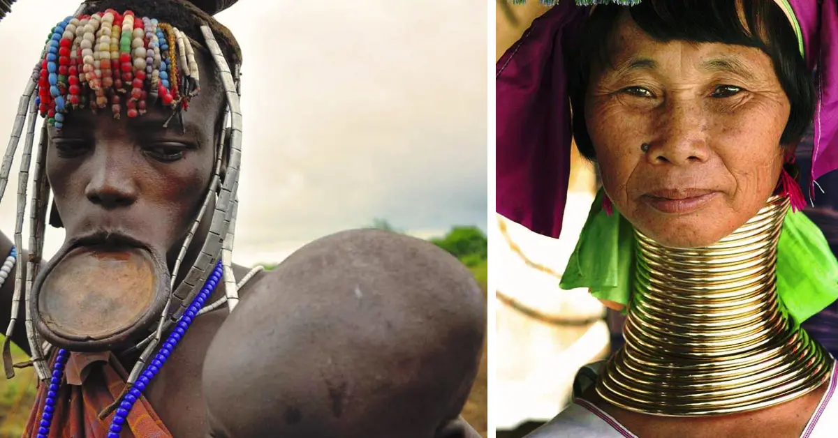 10 Extrañas deformaciones del cuerpo llevadas al extremo que siguen existiendo en el mundo