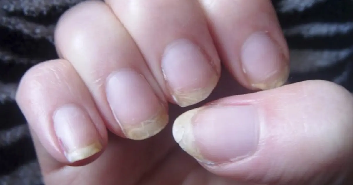 ¿Se te suelen romper las uñas y se te cae el pelo con facilidad? ¡Aquí tienes la solución!