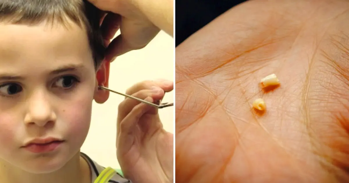 11 Cosas de infarto que los médicos han llegado a sacar de los oídos de sus pacientes