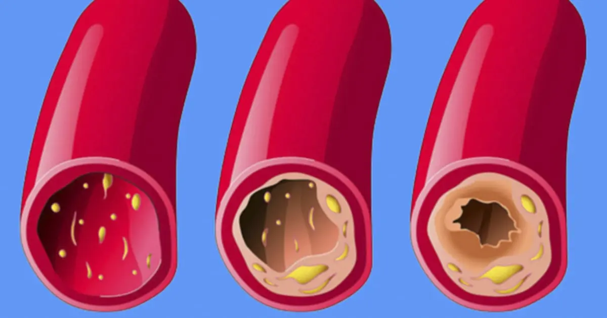3 Ingredientes se viralizan al ser capaces de limpiar las arterias coronarias
