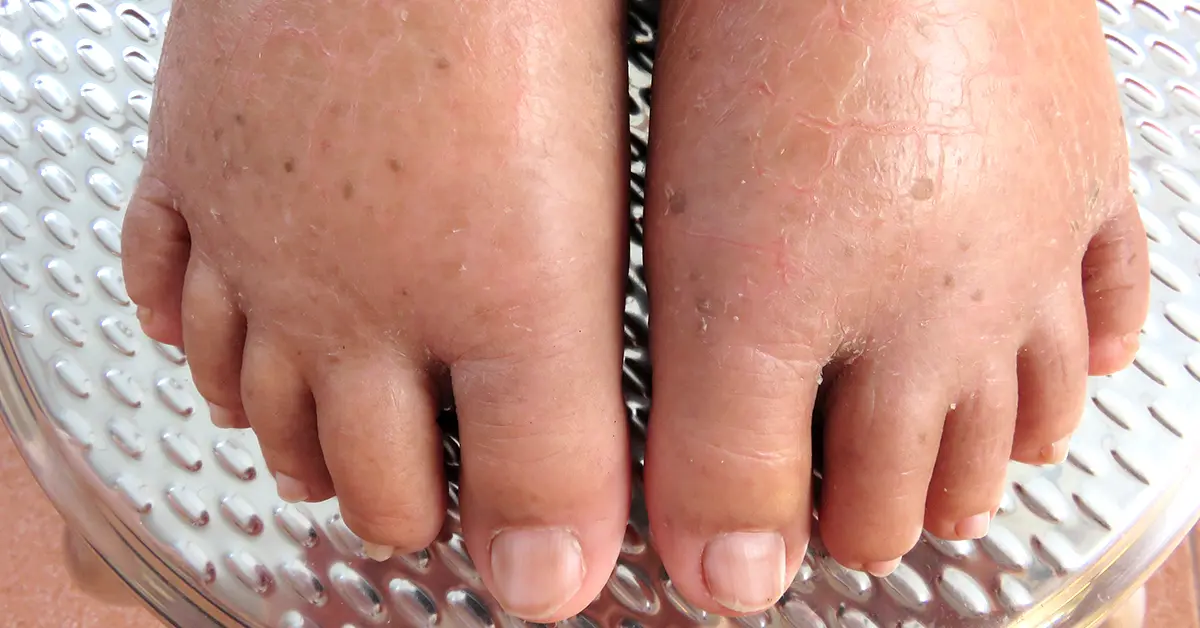 5 Trucos rápidos para deshacerte de la retención de líquidos cuando estás hinchado