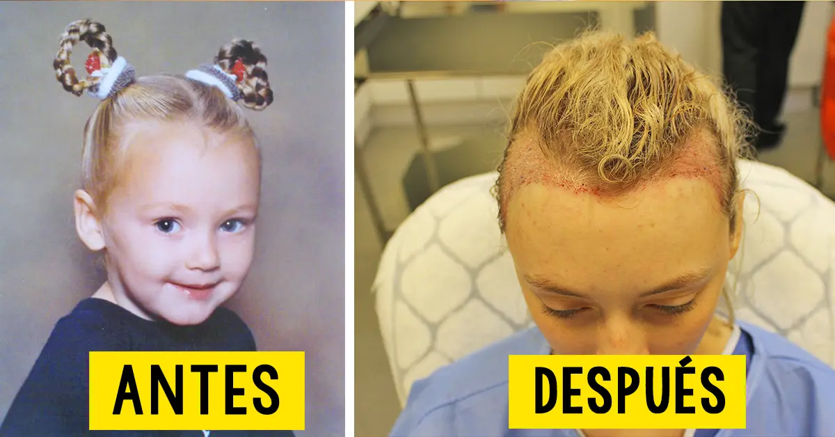 Sufrió las consecuencias de llevar el pelo recogido durante muchos años, pero los médicos tenían una solución