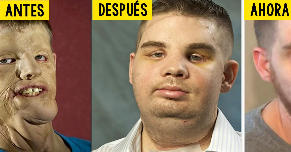 Le hicieron el trasplante de cara más caro de la historia. Cinco años después este es su increíble aspecto