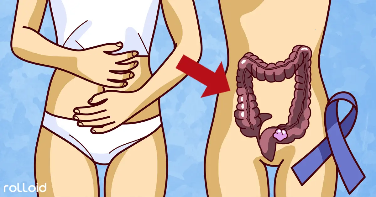 5 Avisos del cuerpo que indican cuándo podrías tener cáncer de colon