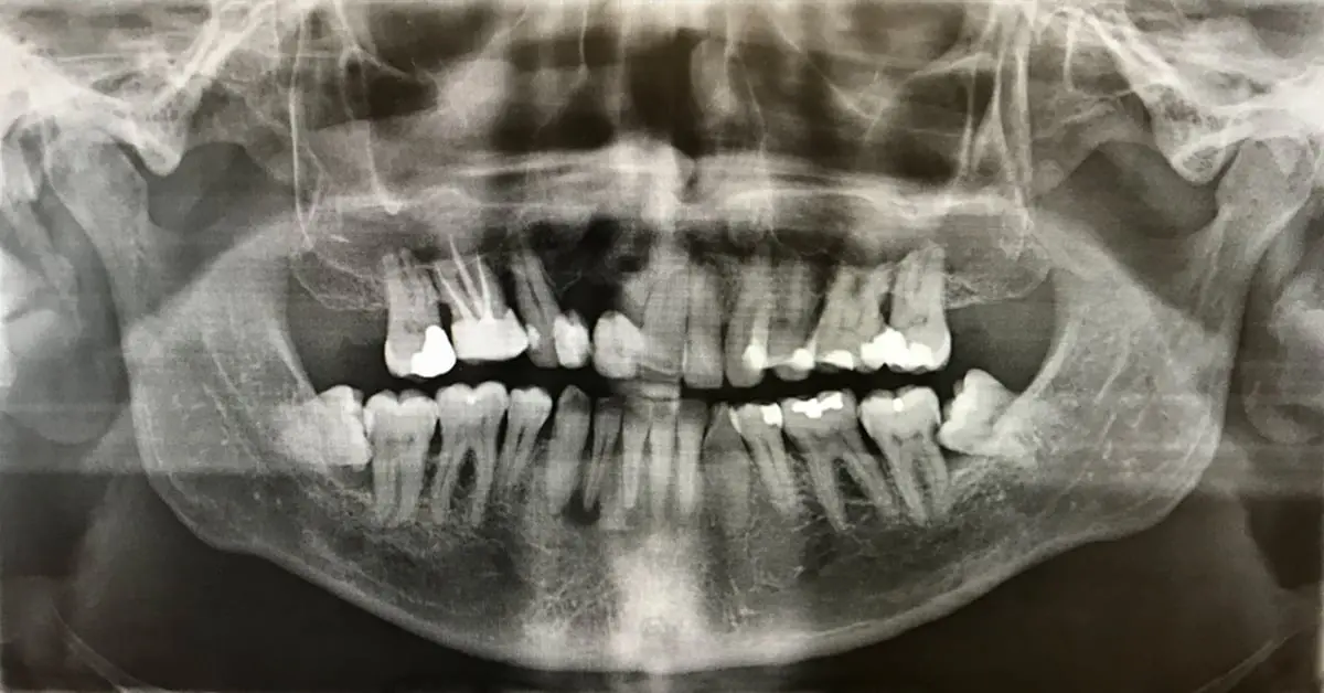 Un dentista hace crecer los dientes en 9 semanas para no tener que usar más implantes dentales