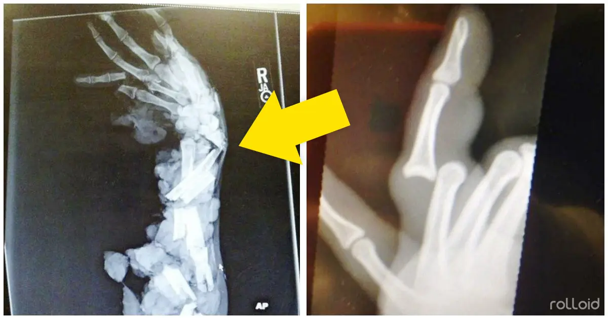 12 Pesadillas de Rayos X que harán retorcerte de dolor nada más verlas