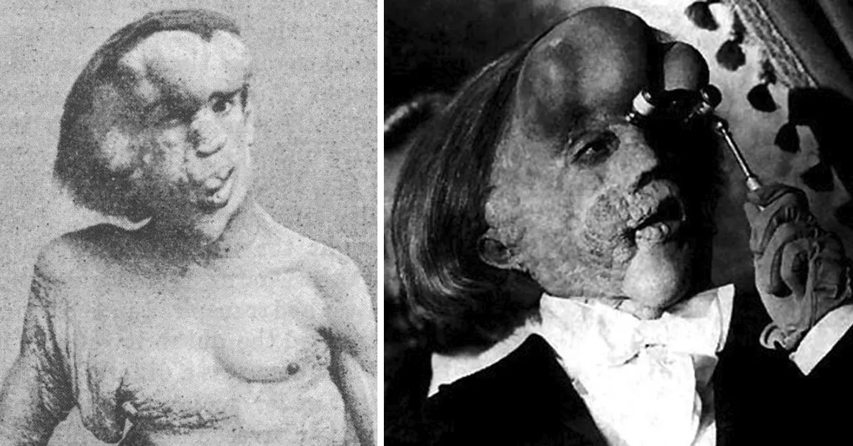 7 Curiosidades sobre el hombre elefante y su singularidad personalidad