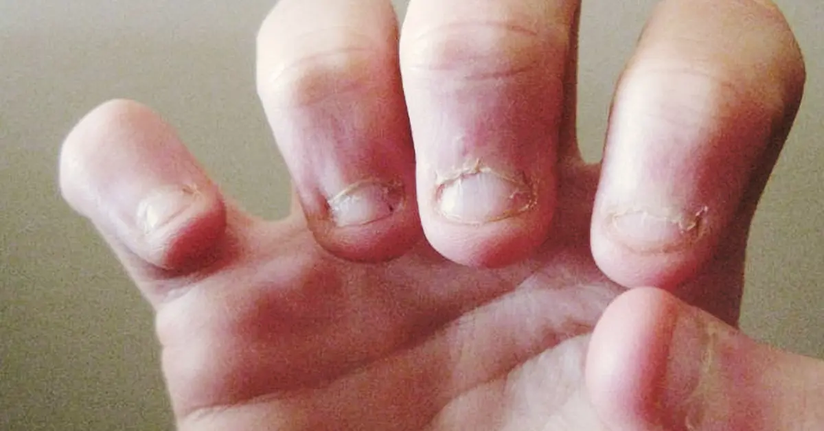 3 Razones por las que a veces puedes tener ganas incontrolables de morderte las uñas