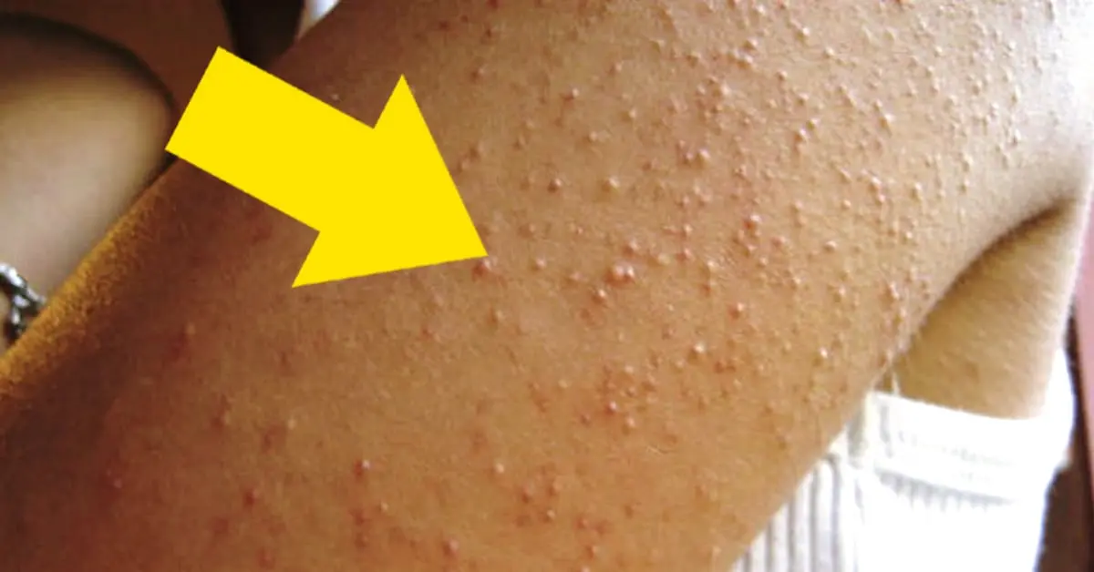 ¿Te han aparecido alguna vez ronchas rojas como estas por los brazos? Esta podría ser la causa