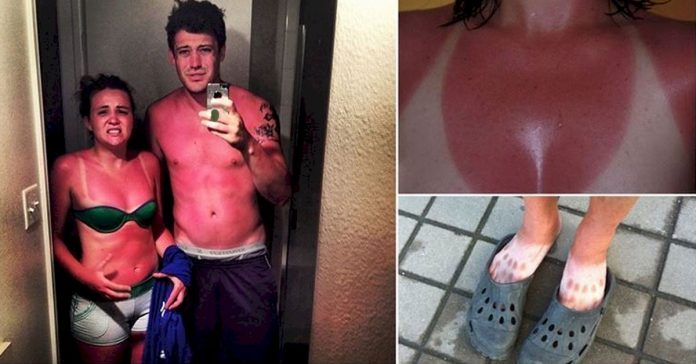 20 Situaciones en las que el Sol gano la batalla al protector solar banner