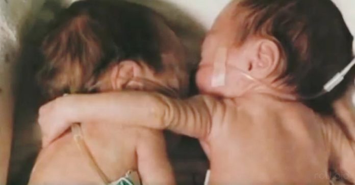 gemelas abrazo sobreviven
