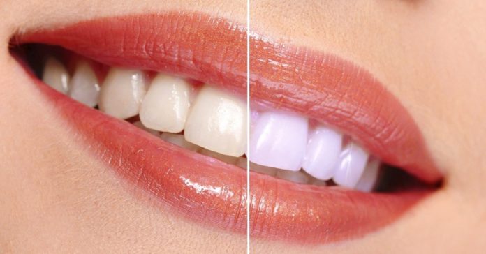 9 maneras sorprendentes para blanquear los dientes banner