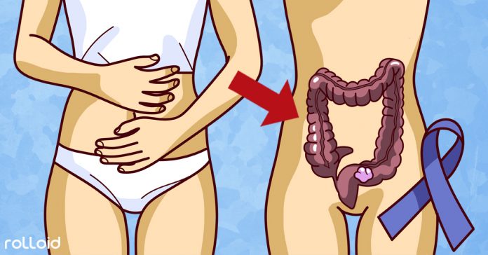 5 Avisos del cuerpo que indican que se puede tener cáncer de colon 2 cuales son los sintomas del cancer de colon banner