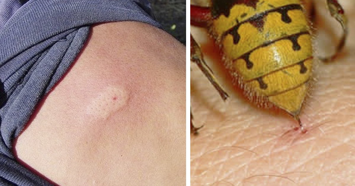  Qu Hacer Si Me Pica Una Abeja Gu a Para El Manejo Seguro De Picaduras