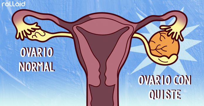 8 maneras de reducir los quistes ovaricos banner